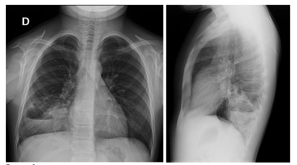 Fig 1. Frontal and lateral chest radiograph of a 10-year-old patient with history of recurrent respiratory infections. Consolidation in the right lung base with cavitation.