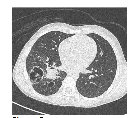 Fig 2. Computed tomography of the patient in Figure 1, three months later. Congenital pulmonary malformations with large and small cystic areas of hyperinflation. No systemic irrigation was observed.
