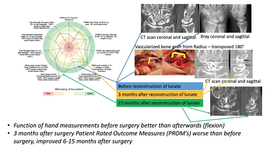 Figure 2a: The consensus wrist index for case 2.