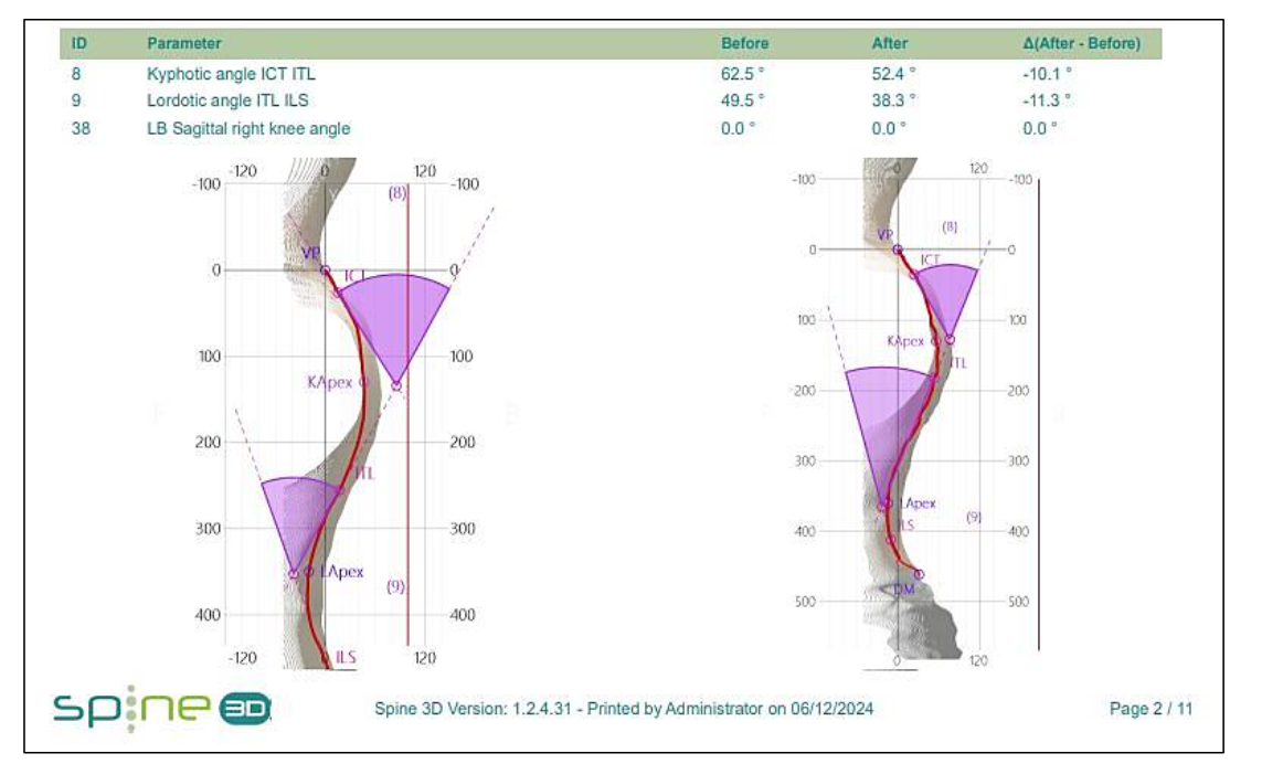 Fig. 3 – Spine3D LIDAR scan showing improvements in thoracic kyphosis and lumbar lordosis.