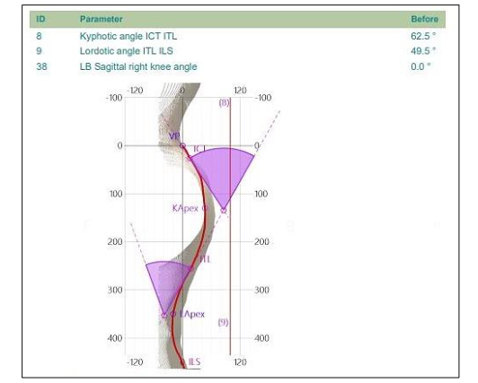 Fig. 1 – Spine3D LIDAR scan used to estimate thoracic kyphosis prior to x-rays, and for future comparison.