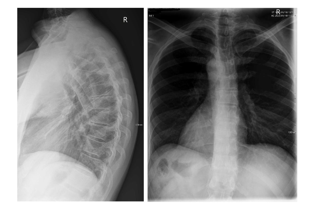 Fig. 2 – Thoracic lateral and PA x-rays showing a thoracic hyperkyphosis with Sorenson's signs.
