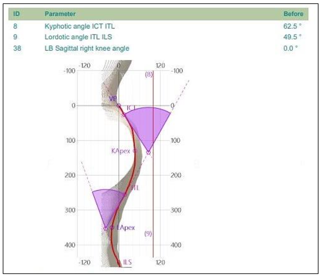 Fig. 1 – Spine3D LIDAR scan used to estimate thoracic kyphosis prior to x-rays, and for future comparison
