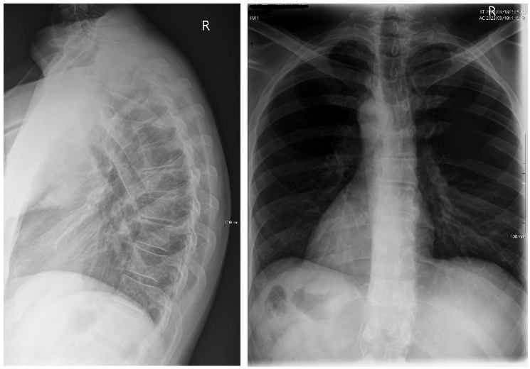 Fig. 2 & 3 – Thoracic lateral and PA x-rays showing a thoracic hyperkyphosis with Sorenson's signs