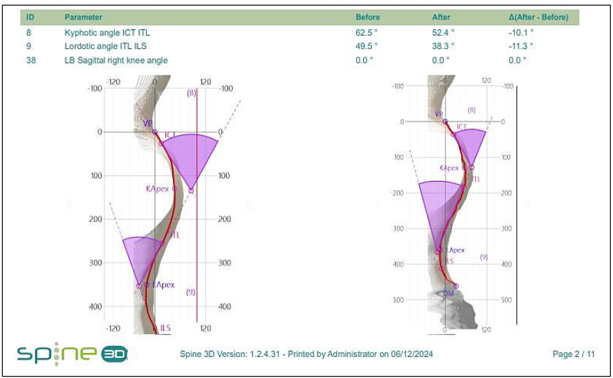 Fig. 4 – Spine3D LIDAR scan showing improvements in thoracic kyphosis & lumbar lordosis