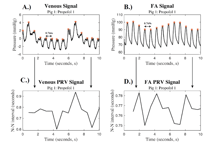 Figure 2: Signal Extraction Waveforms: A.) Filtered venous pressure waveform with N-N intervals marked and B.) the simultaneously filtered FA pressure waveform with N-N intervals marked for porcine subject 1 during Propofol 1. An orange (*) denotes pulses in the pressure waveforms. The corresponding pulse rate variability signals for C.) the venous signal and D.) the FA signal.