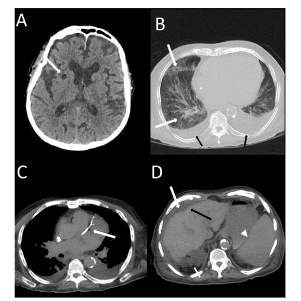 Figure 2. 87-year-old male COVID-19 patient who died. The axial image of brain CT scan without contrast (A) shows an old lacunar brain stroke. The axial image of a chest CT scan, with lung window (B) shows around 55% of ground glass opacity and reticular interstitial lesions (long arrows) and bilateral pleural effusion (black arrows). The axial images with the mediastinal window (C-D) exhibit severe calcifications the aorta and on the left coronary artery and its mean branches (C; long arrow). There are also signs of chronic liver disease with irregular liver surface (D; black arrow), ascites (D; long white arrow), polycystic kidney (D; short arrow), splenomegaly (D; arrowhead).