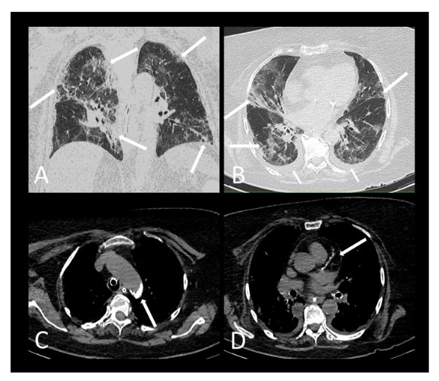 Figure 3. Chest CT scan of 86 year-old COVID-19 female patient who died. The lung window of coronal (A) and axial images (B) show more than 55% of ground glass opacity and reticular interstitial lesions (long arrows) of COVID-19 pneumonia and laminar bilateral pleural effusion (short arrows). The mediastinal window (C,D) shows calcifications at the cross section of the aorta (arrow, C) and moderate coronary calcifications in the proximal segment of left coronary artery (arrow, D).