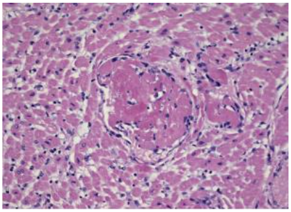 Fig. 1. Microscopic study of the heart from a deceased infant with COVID-19. Numerous microvessels of the heart are visible, showing an uncontrolled inflammatory reaction.