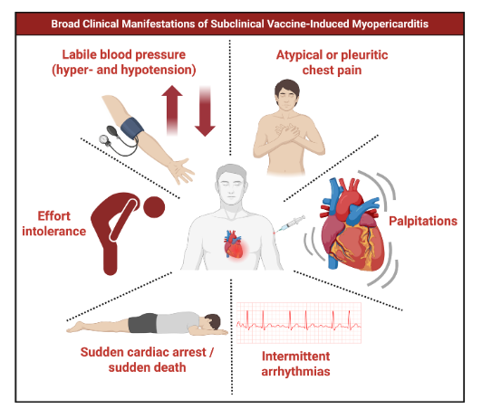 Figure 1. Broad Clinical Manifestations of Subclinical Vaccine-Induced Myopericarditis. This figure illustrates the broad spectrum of clinical manifestations associated with subclinical COVID-19 vaccine-induced myopericarditis. Unlike overt cases, affected individuals typically lack obvious symptoms such as severe chest pain or dyspnea. Instead, more subtle cardiovascular signs may appear, including atypical or pleuritic chest pain, palpitations, intermittent arrhythmias, labile blood pressure with both hyper- and hypotensive episodes, and effort intolerance. In certain cases, the first clinical presentation may be catastrophic, with sudden cardiac arrest or sudden death representing the most severe end of the continuum. These features underscore the importance of proactive screening and surveillance to identify subclinical cases early and prevent life-threatening outcomes.