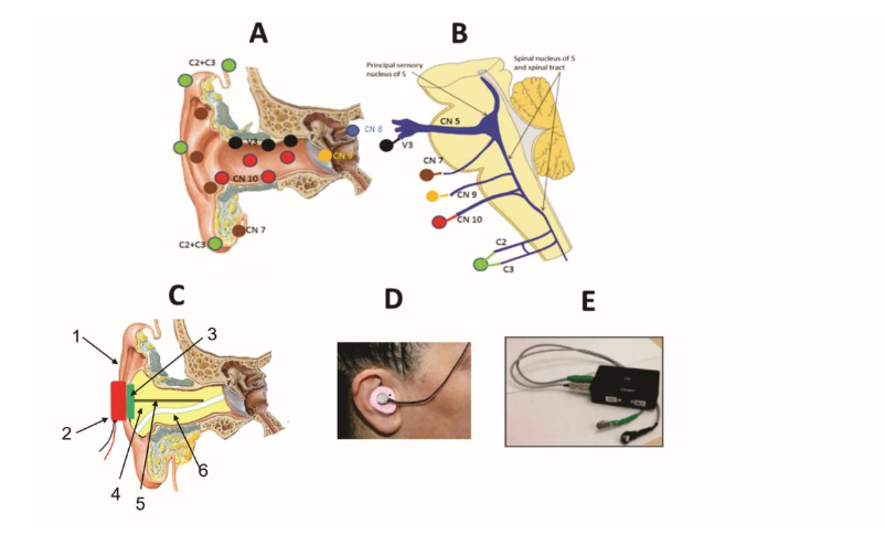 Figure 1. A. Cranial and cervical nerve sensory fields. B. Nociceptive fiber projections to CN5 spinal nucleus. C. Pinna 1, Vibratory motor 2, with cemented magnet, latches to a second magnet 3, embedded in silicon material 4, transmits vibration to sensory fields via a metal bar, 5. Air conduit for relief of air pressure, 6. D. Device position on subject. E. Power supply, leads, and vibratory discs.