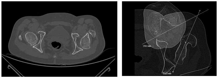 Patient with bilateral spastic cerebral palsy of the diplegic type. Painful posterior left hip subluxation after three derotation osteotomies due to internal rotation gait with recurrency. The CT proves a retroversion of 40°.