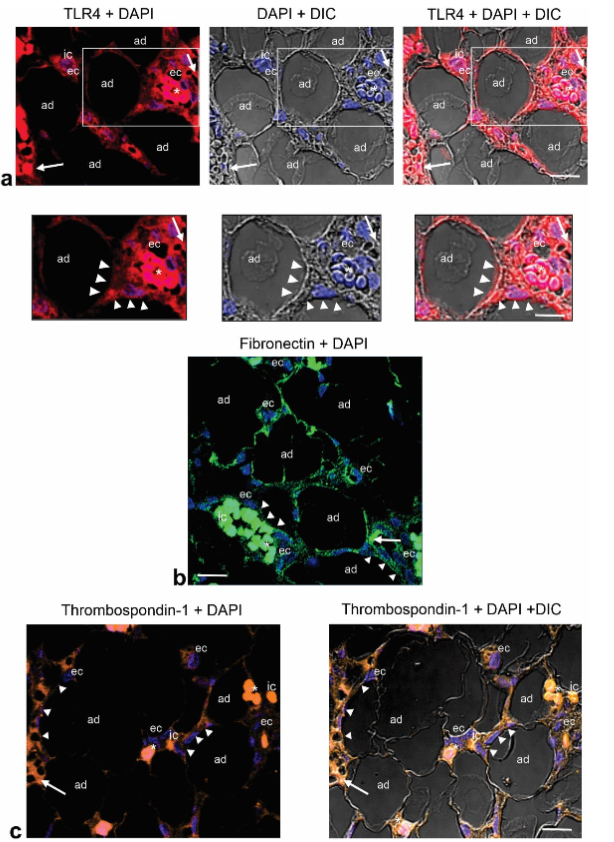 Fig. 3a-c. Representative CLSM fluorescence images of TLR4, FN, and TSP-1 in the angiolipoma located on thigh. TLR4 (a), FN (b) and TSP-1 (c) are immunolocalized around the mature adipocytes (ad) that are in close proximity to dilated and tortuous small blood vessels (arrowheads) containing fibrin microthrombi (arrows), as well as in the ECs (ec) lining the vessel lumen and some immune cells (ic). Enlargements show the immunoreactivity for TLR4 in the mature adipocyte (ad) in close proximity to the small blood vessels (arrowheads) and ECs (ec). Blue, nuclear DAPI staining; DIC, differential interference contrast image; red blood cells (asterisk). Scale bars: 45µm, 35µm (a); 35µm (b,c).