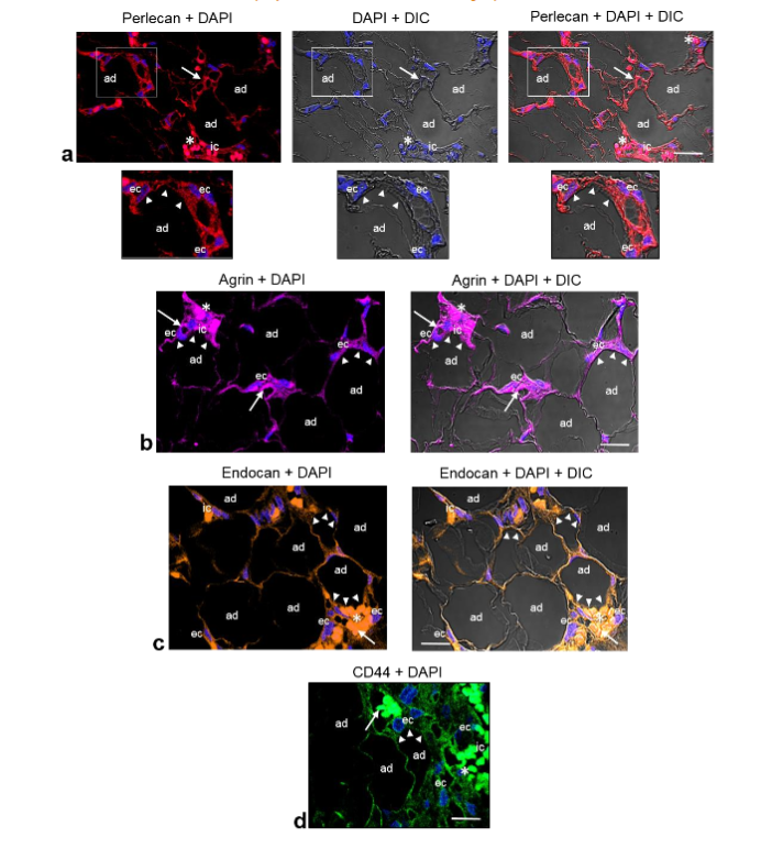 Fig. 2a-d. Representative CLSM fluorescence images of perlecan, agrin, and endocan in one biopsy of angiolipoma located on thigh, and CD44 in one biopsy of angiolipoma located on arm. Perlecan (a), agrin (b), endocan (c), and CD44 (d) are immunolocalized around the mature adipocytes (ad) that are in close proximity to dilated and tortuous small blood vessels containing fibrin microthrombi (arrows), as well as in the ECs (ec) lining the vessel lumen and some immune cells (ic). Enlargements show the immunoreactivity for perlecan in the mature adipocyte (ad) in close proximity to the small blood vessels (arrowheads) and ECs (ec). Blue, nuclear DAPI staining; DIC, differential interference contrast image; red blood cells (asterisk). Scale bars: 70µm, 55µm (a); 45µm (b-d).