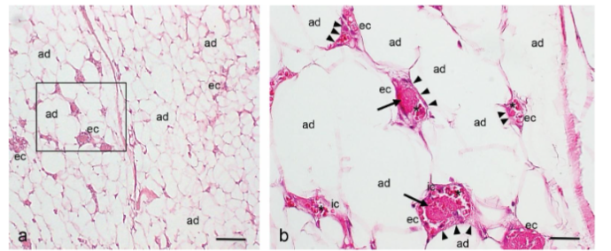 Fig. 1a,b. Hematoxylin (H&E) staining from a biopsy of angiolipoma tissue located on thigh showing the mature adipocytes (ad) close to dilated and tortuous small blood vessels (arrowheads) containing fibrin microthrombi (arrows), red blood cells (asterisks), and immune cells (ic). ec, endothelial cells. Scale bars: 140 µm; 35µm.