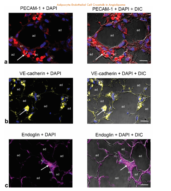 Fig. 5a-d. Immunostaining of PECAM-1 (CD31), VE-cadherin, endoglin, and VEGFR2 in the same biopsy (thigh). PECAM-1 (CD31) (a), endoglin (b), VE-cadherin (c) and VEGFR2 (d) are located in the ECs (ec) lining the lumen of the tortuous and dilated small blood vessels containing intraluminal microthrombi (arrows). Moderate PECAM-1 (CD31) and endoglin immunostaining is also observed in some immune cells (ic). Enlargement show the immunoreactivity for VEGFR2 in the ECs (ec). Blue, nuclear DAPI staining; DIC, differential interference contrast image; red blood cells (asterisk). Scale bar: 25µm (a); 35µm (b,c); 35µm, 20µm (d).