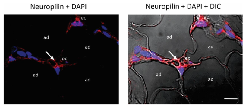 Fig. 6. Immunolocalization of neuropilin-1 (NRP-1) in the same biopsy (thigh). NRP-1 is localized in the luminal ECs (ec) of the tortuous and dilated small blood vessels containing microthrombi (arrows). Blue, nuclear DAPI staining; DIC, differential interference contrast image; ad, adipocytes. Scale bar: 35µm.