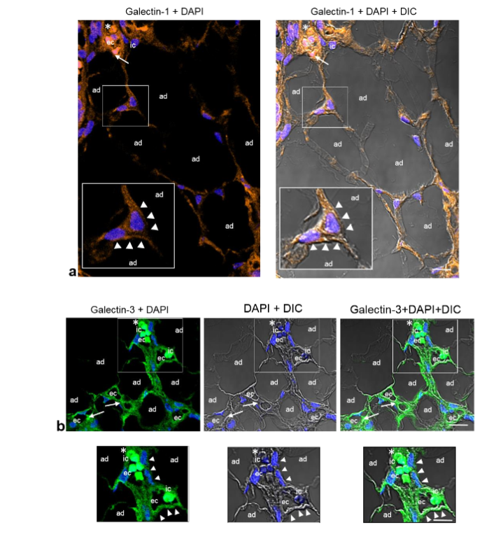 Fig. 7a-c. Representative CLSM fluorescence images of GAL-1, GAL-3, and GAL-8 in the same biopsy (thigh). GAL-1 (a), GAL-3 (b) and GAL-8 (c) are located around the mature adipocytes (ad) that are in close proximity to dilated and tortuous small blood vessels containing fibrin microthrombi (arrows), as well as in the ECs (ec) lining the vessel lumen and some immune cells (ic). Enlargements show the corresponding immunoreactivities in the mature adipocytes (ad) in close proximity to the small blood vessels (arrowheads), ECs (ec), and immune cells (ic). Blue, nuclear DAPI staining; DIC, differential interference contrast image; red blood cells (asterisk). Scale bars: 35µm, 20µm (a); 35µm, 25µm (b); 35µm, 20µm (c).