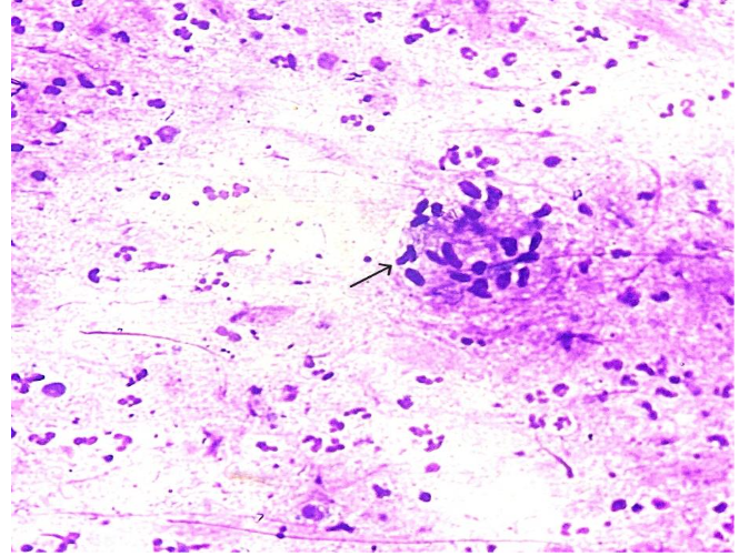 Fig 1: FNAC - Smear shows granulomatous inflammation (Black Arrow) in a background of polymorphs. (High power view x 40).