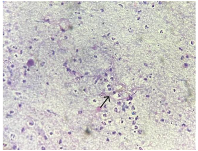 Fig 2: Smear shows branching and septate hyphae (black arrow) in a background of necrosis and acute inflammation (H & E) (low power view 10x).