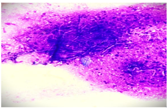 Fig 4: Histopathology shows dense inflammation with multiple giant cells and aspergillus hyphae and spores (black arrows) (H & E stain, High power view x 40).