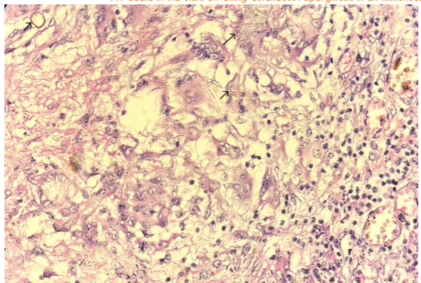 Fig 4: Histopathology shows dense inflammation with multiple giant cells and aspergillus hyphae and spores (black arrows) (H & E stain, High power view x 40).