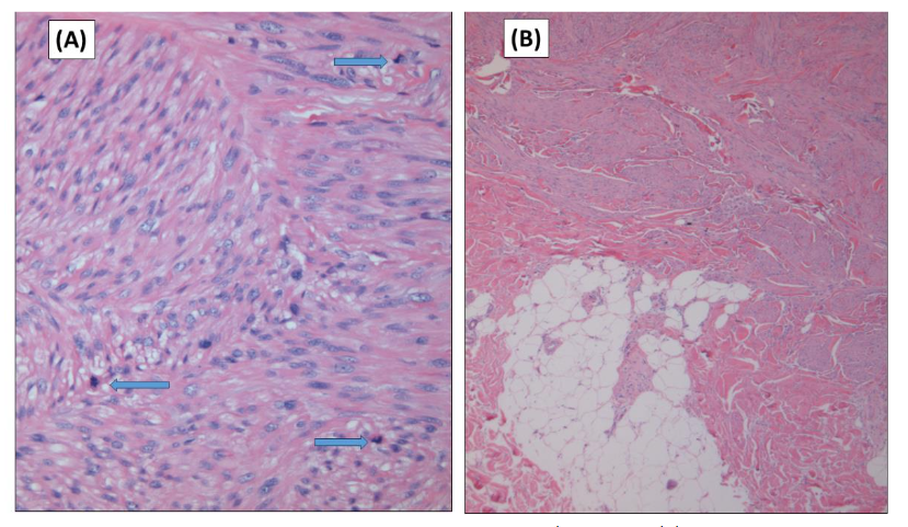 Figure 2. A. Higher magnification of the neoplasm. Numerous mitoses are noted (Blue arrows) (Hematoxylin and Eosin stain x 100). B. The neoplasm is confined to the superficial dermis with no infiltration of the subcutaneous adipose tissue (Hematoxylin and Eosin stain x 25).