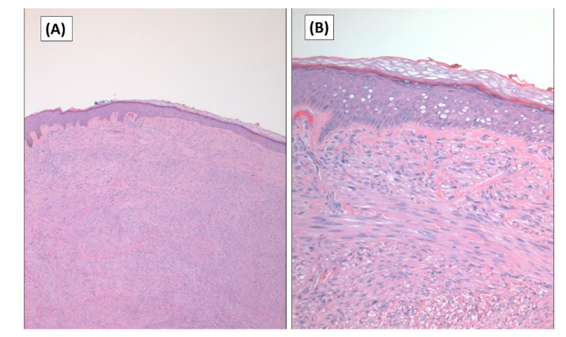 Figure 1. Histologic features of cutaneous leiomyosarcoma. A. Sections shows a dermal based soft tissue neoplasm. The overlying epidermis is unremarkable (Hematoxylin and Eosin stain x 25). B. Higher magnification showing fascicles of elongated spindled cells with elongated nuclei, abundant eosinophilic cytoplasm and mild cytologic atypia. The overlying epidermis is unremarkable (Hematoxylin and Eosin stain x 100).