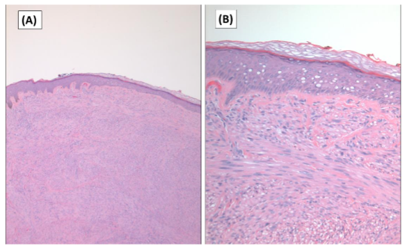 Figure 1. Histologic features of cutaneous leiomyosarcoma. A. Sections shows a dermal based soft tissue neoplasm. The overlying epidermis is unremarkable (Hematoxylin and Eosin stain x 25). B. Higher magnification showing fascicles of elongated spindled cells with elongated nuclei, abundant eosinophilic cytoplasm and mild cytologic atypia. The overlying epidermis is unremarkable (Hematoxylin and Eosin stain x 100).