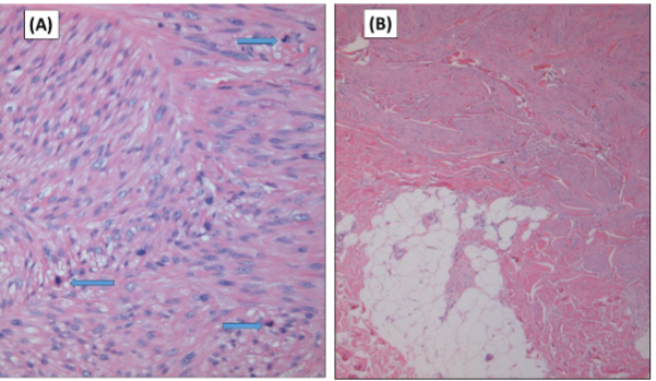 Figure 2. A. Higher magnification of the neoplasm. Numerous mitoses are noted (Blue arrows) (Hematoxylin and Eosin stain x 100). B. The neoplasm is confined to the superficial dermis with no infiltration of the subcutaneous adipose tissue (Hematoxylin and Eosin stain x 25).