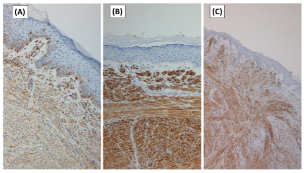 Figure 3. Immunohistochemical studies confirm smooth muscle origin of the neoplasm. The lesional cells show positivity for vimentin, smooth muscle actin, and desmin.
