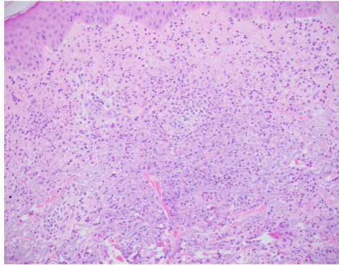 Figure 4. Sweet Syndrome, Clinical (Courtesy of Dr. Scott Elman) Indurated, erythematous plaque with few pustules.