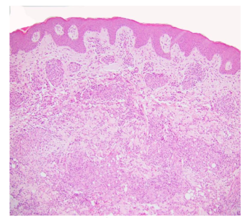 Figure 1. Cutaneous Crohn’s Disease, micro, 100x H&E. The dermis shows noncaseating granulomas.