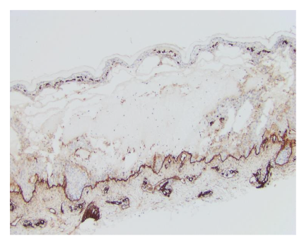 Salt split skin showing deposition along the dermal side of the split.