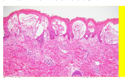 In this well-developed lesion, there is a subepidermal blister containing neutrophils most predominantly in the papillary tips and a mild superficial perivascular lymphocytic infiltrate.
