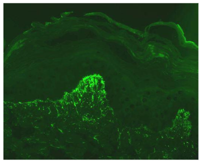 Granular deposition of IgA at the papillary tips.