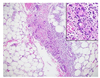 Septal panniculitis characterized by septal edema and a lymphohistiocytic infiltrate with neutrophils and Meischer’s granulomas.