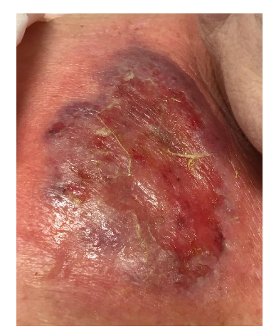 Indurated, erythematous plaque with few pustules.