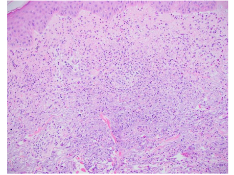 Beneath the epidermis there is a collection of perivascular and interstitial neutrophils without vasculitis.