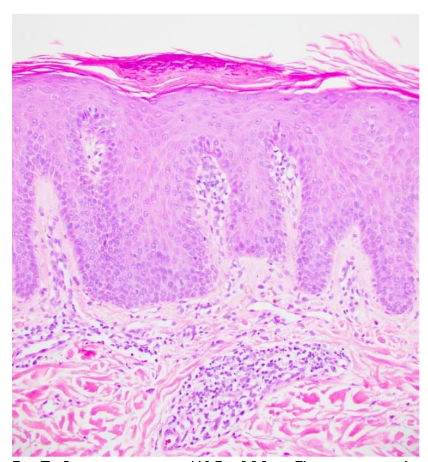 There is regular acanthosis with parakeratosis and neutrophilic microabscesses of Munro in the stratum corneum.