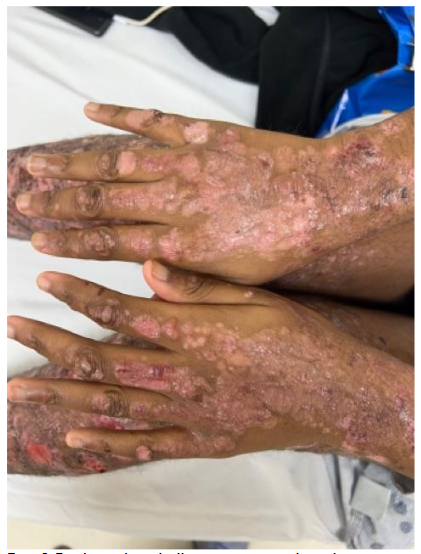 The hands and legs are involved by erosions with various degrees of healing characterized by atrophic scars and hyper and hypopigmentation.