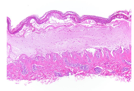 In this bullous pemphigoid-like variant, there is a subepidermal blister with few eosinophils. In the dermis there is a perivascular lymphocytic infiltrate with eosinophils.
