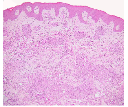 The dermis shows noncaseating granulomas.