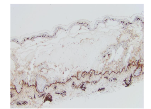 Figure 10. Epidermolysis bullosa acquisita, micro, Immunoperoxidase for Collagen VII, 200x. Salt split skin showing deposition along the dermal side of the split.