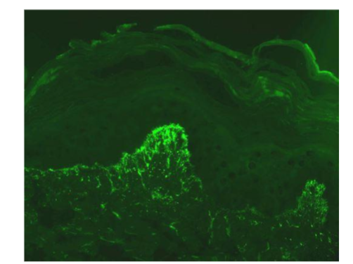 Figure 12. Dermatitis Herpetiformis, Direct immunofluorescence, 400x. Granular deposition of IgA at the papillary tips.