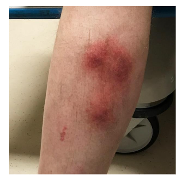 Leg with multiple indurated erythematous nodules on extensor surface of leg.