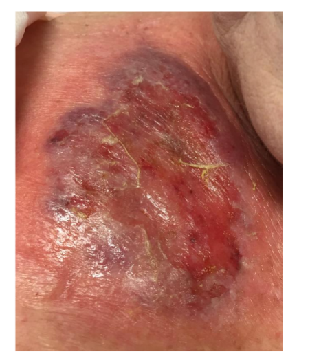Figure 5. Sweet Syndrome, micro, H&E, 200x. Beneath the epidermis there is a collection of perivascular and interstitial neutrophils without vasculitis.