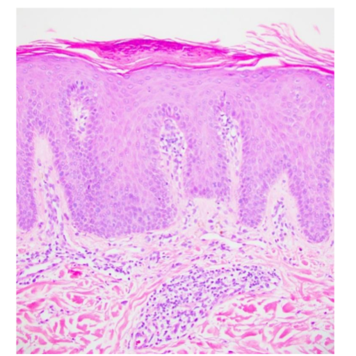 Figure 7. Psoriasis, micro H&E, 200x. There is regular acanthosis with parakeratosis and neutrophilic microabscesses of Munro in the stratum corneum.