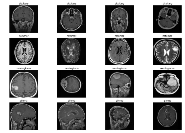 Data Augmentation Results. Examples of augmented MRI brain tumor images.