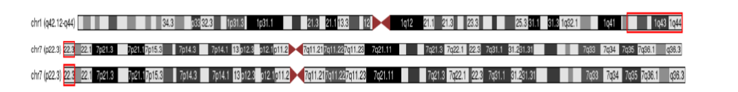 Chromosome microarray results; arr [hg19] 1q42.12q44(226,602,460-249,224,683 X3, 7p22.3 (42,360-2,799,184 X1 shown in Santa Clara Genome Browser. Top; all chromosome 1, showing chromosome 1q duplication. Middle; all chromosome 7 showing chromosome 7p deletion. Bottom; enlargement of 7p chromosome showing chromosome 7p deletion.